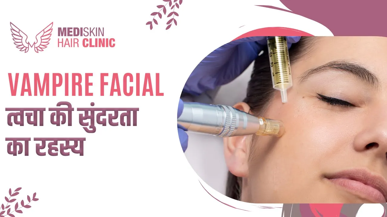 Vampire Facial